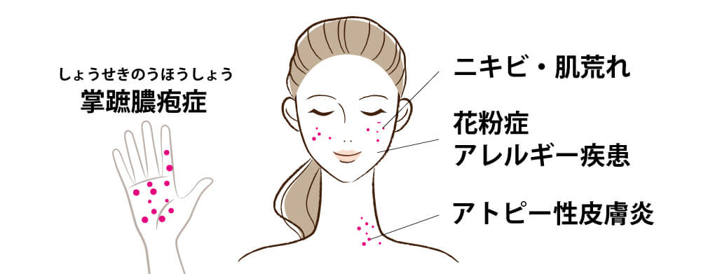 ビオチン療法が有効とされる疾患