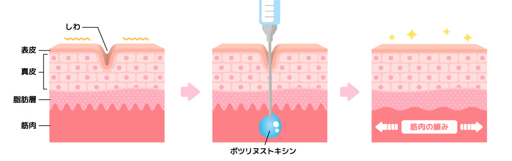 ボトックス注射の作用