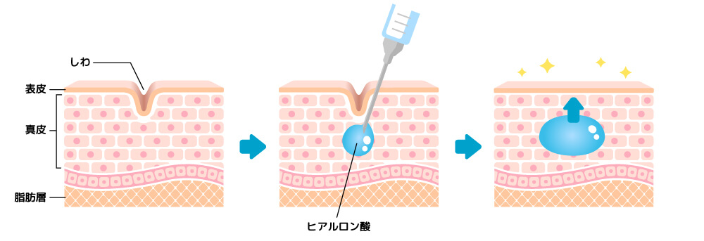 ヒアルロン酸の作用