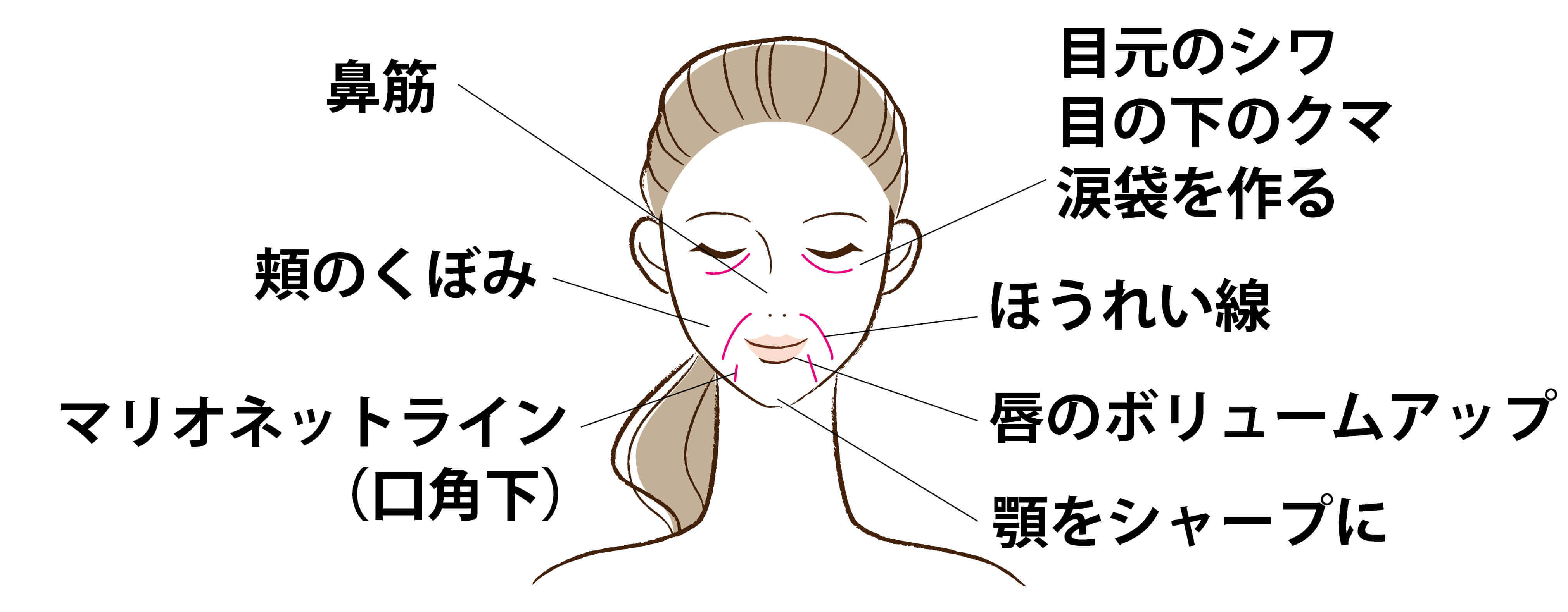 ヒアルロン酸の注入部位