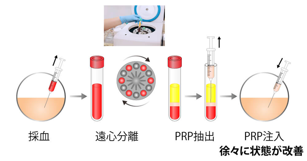 ACR療法の作用