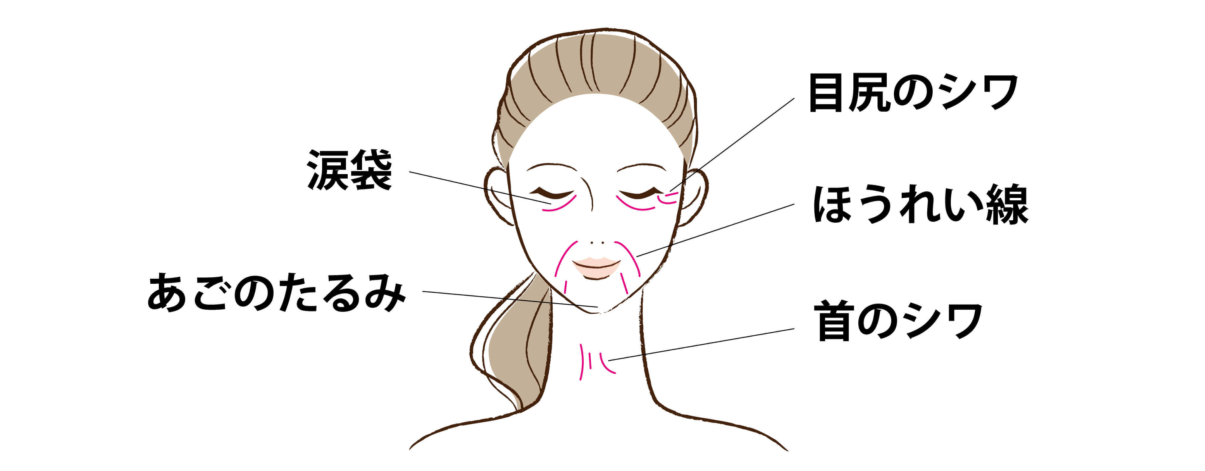 ACR療法の注入部位